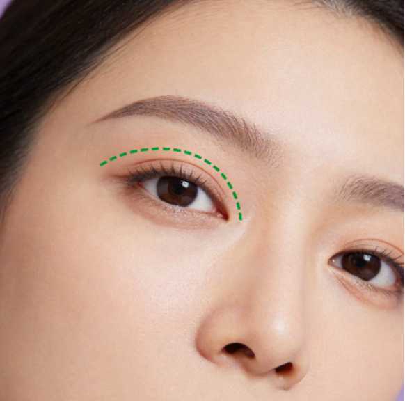部分切开双眼皮.jpg