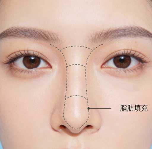 自体脂肪隆鼻