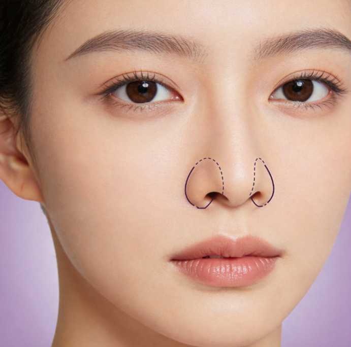 鼻翼软骨缝合