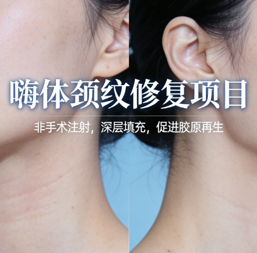 嗨体颈纹