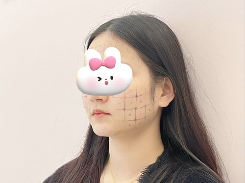 成都艺星整形医院周觅擅长热玛吉