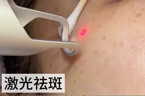 成都艺星整形医院杜鹃擅长激光祛斑