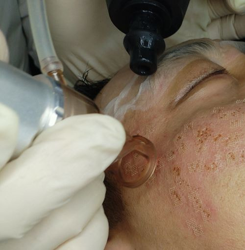 成都艺星整形医院杜鹃去痘坑好