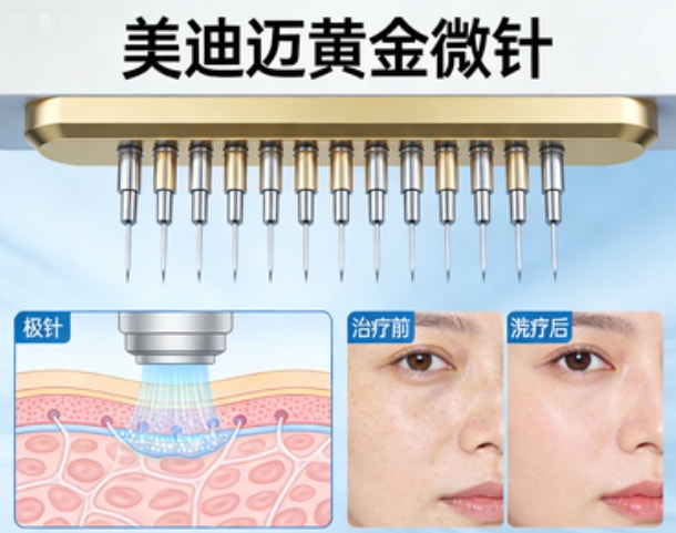 美迪迈黄金微针