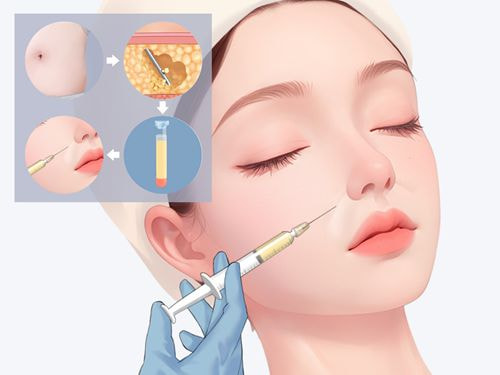 梁静萍医生擅长注射玻尿酸