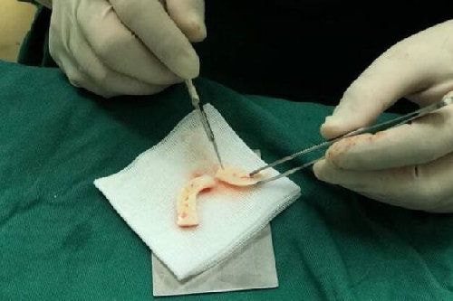 肋骨鼻综合.jpg