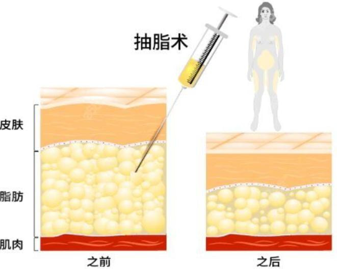 吸脂对比.jpg