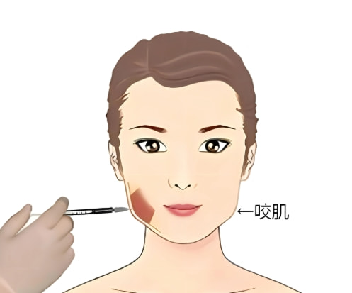 注射玻尿酸下巴6.png