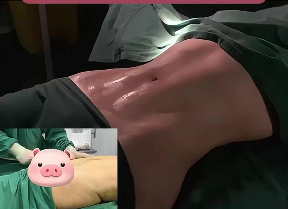 腰腹吸脂效果.jpg