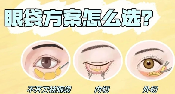 微创祛眼袋 不开刀去眼袋