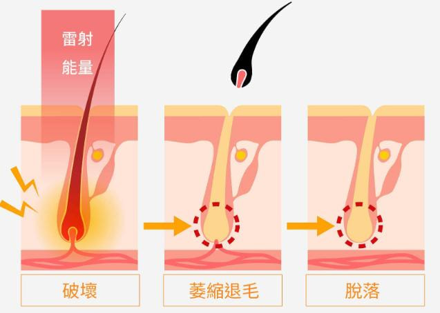 激光脱毛/冰点脱毛/唇毛腋毛2选1丨3年卡提前预约/私信有礼