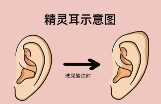 精灵耳