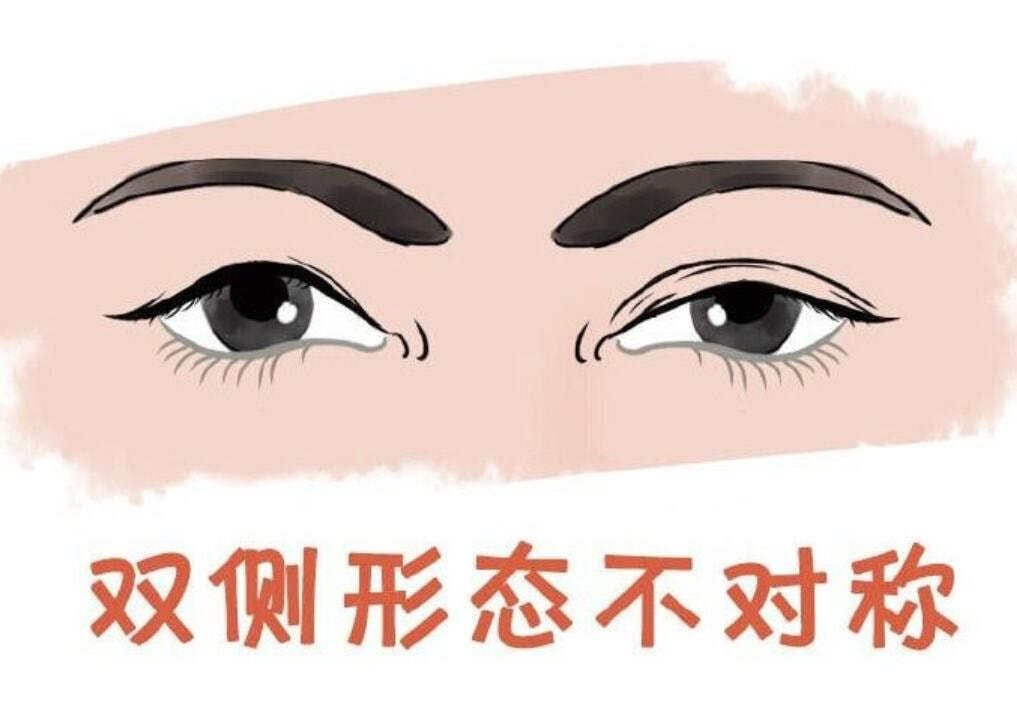 双眼皮不对称.jpg