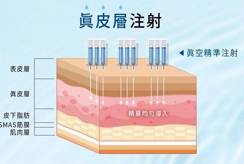 菲欧曼 135HA 填充针