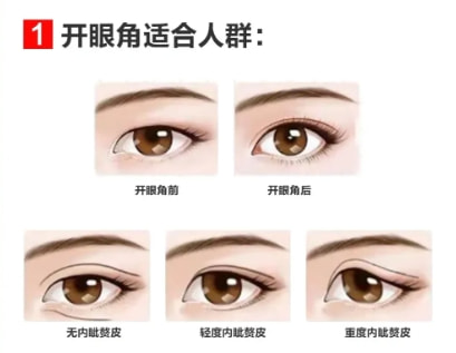 开眼角