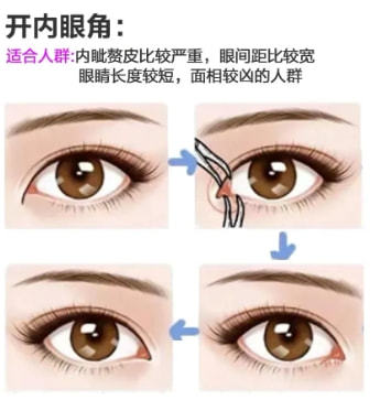 开眼角