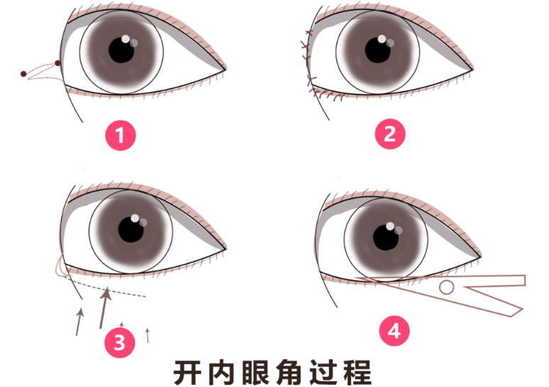 开眼角