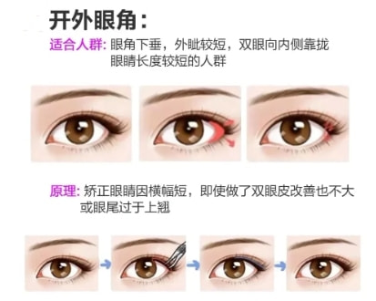 开眼角
