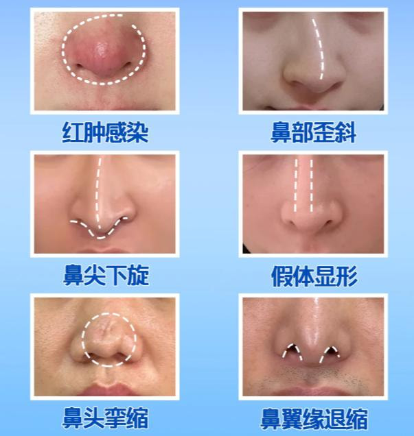 鼻修复.jpg