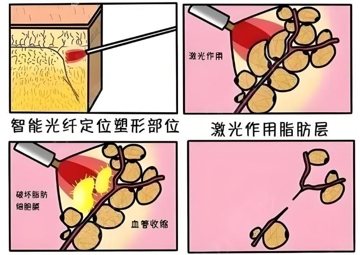激光溶脂.jpg