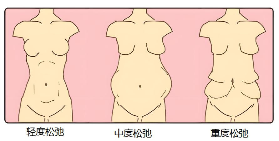 腹壁成形4.jpg