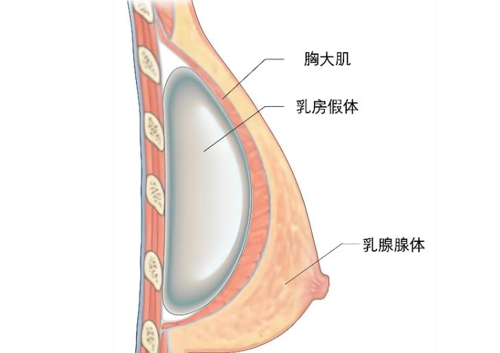 隆胸假体取出4.jpg
