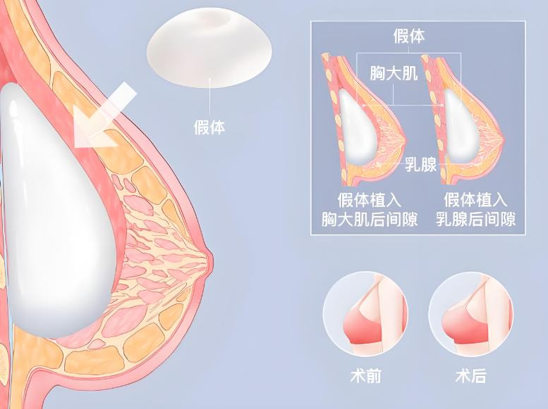 注射物(假体)取出