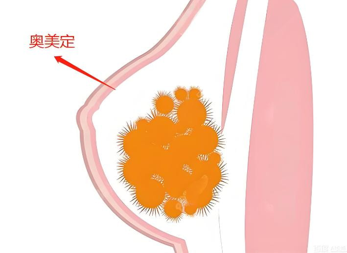 奥美定取出
