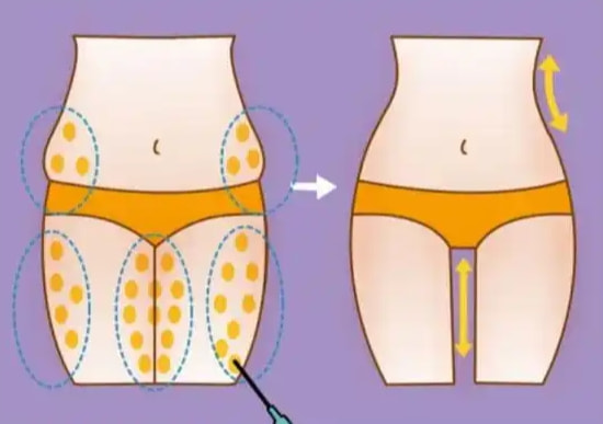 大腿吸脂1.png