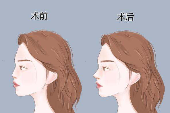 【手术缩鼻】改苦蒜头鼻/鼻翼肥大/大鼻孔