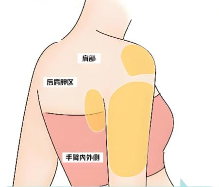 肩膀吸脂5.jpg