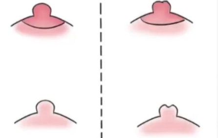 乳晕敏感激活(含嫩红)
