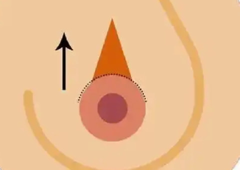 乳头整形