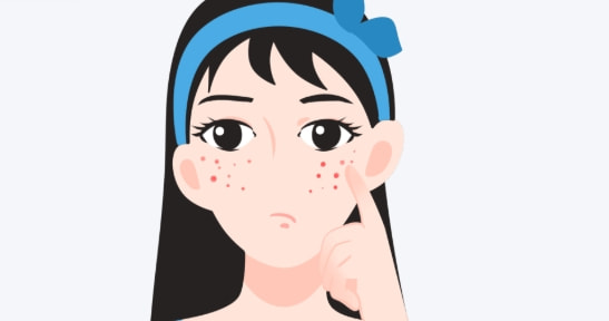 去雀斑.png