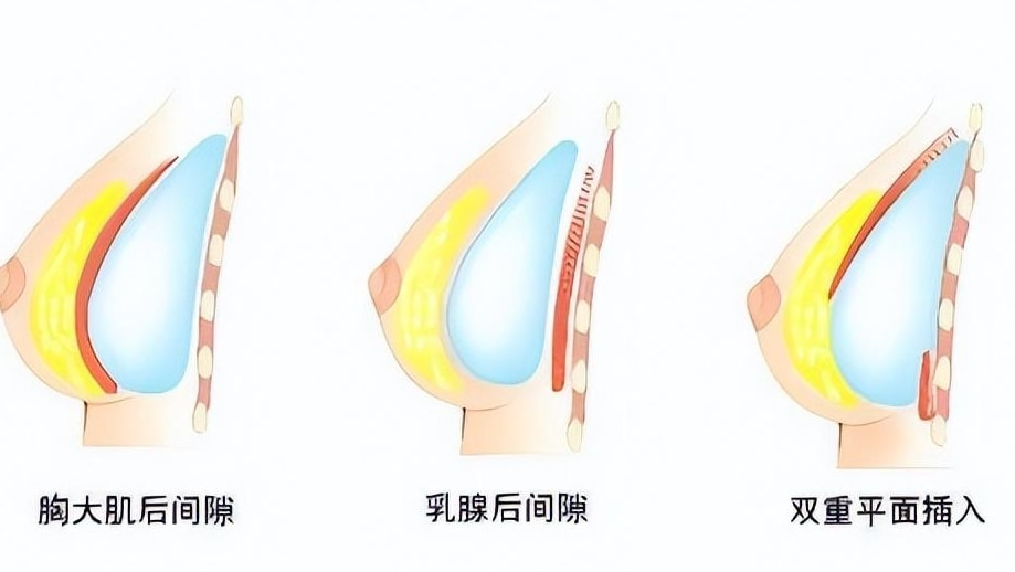 假体丰胸.png