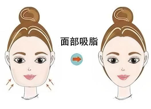 美国品牌瘦脸 + 下颌缘提升 100U:3520 元