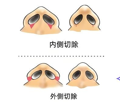 【手术缩鼻翼】鼻部整形缩小鼻翼