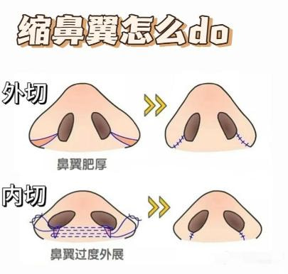 鼻翼缩小1.jpg