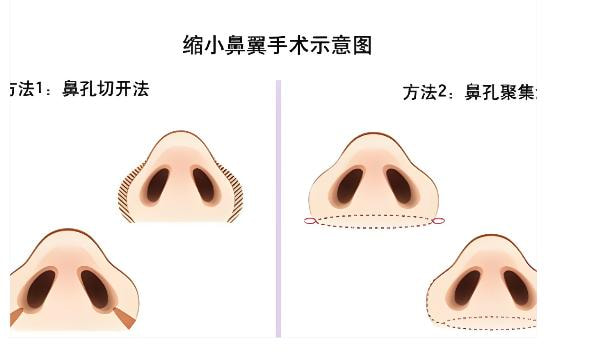 【手术缩鼻翼】鼻部整形缩小鼻翼