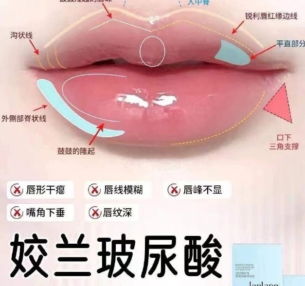 【姣兰玻尿酸】玻尿酸丰唇 唇部塑形
