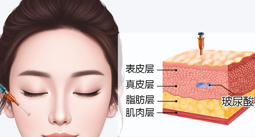 注射玻尿酸.png
