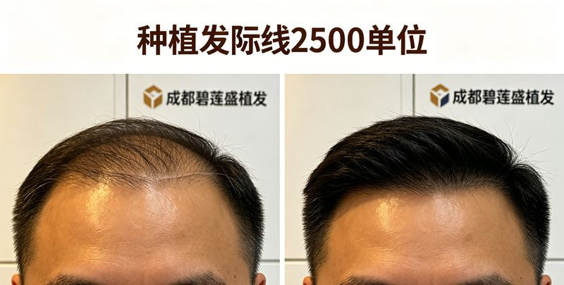 种植发际线2500单位