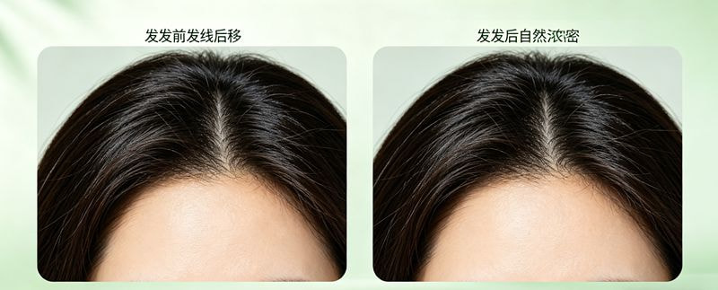 发际线植发