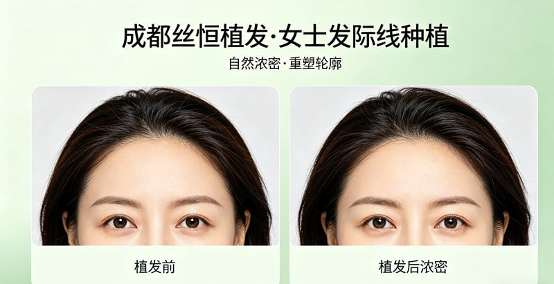 发际线植发