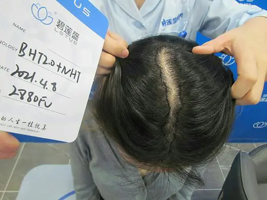 西安碧莲盛植发