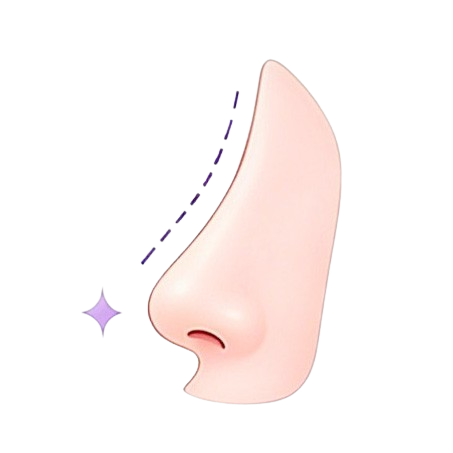 隆鼻