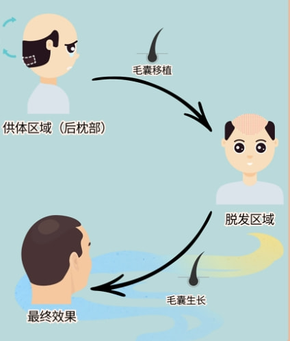 植发5.png