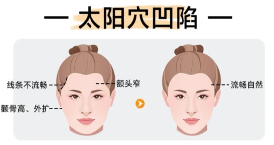 【自体脂肪丰太阳穴】改善太阳穴凹陷