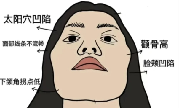【自体脂肪丰太阳穴】改善太阳穴凹陷