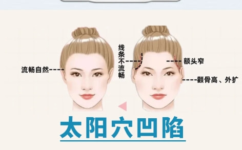 【自体脂肪丰太阳穴】改善太阳穴凹陷